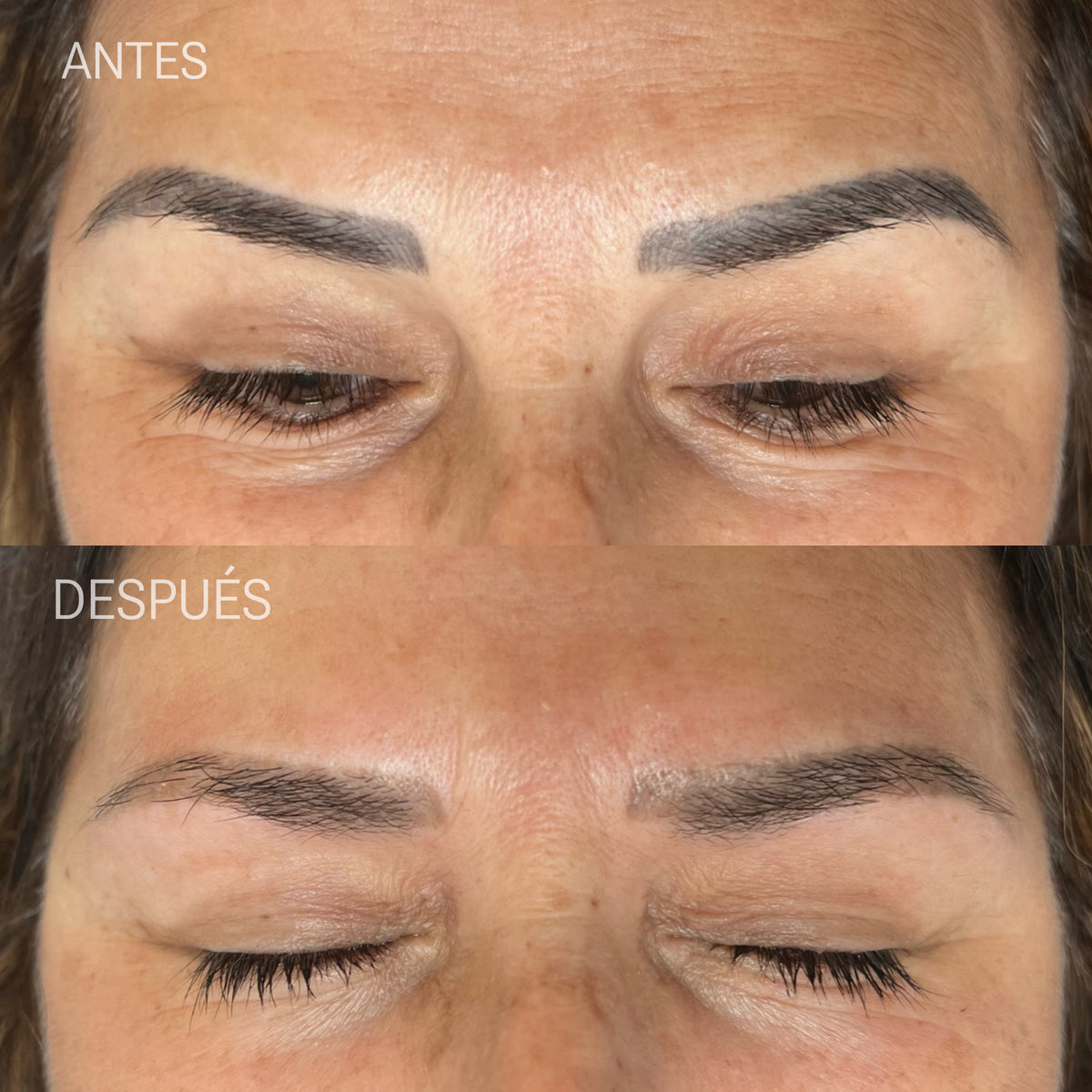 Laser Hair Removal Training