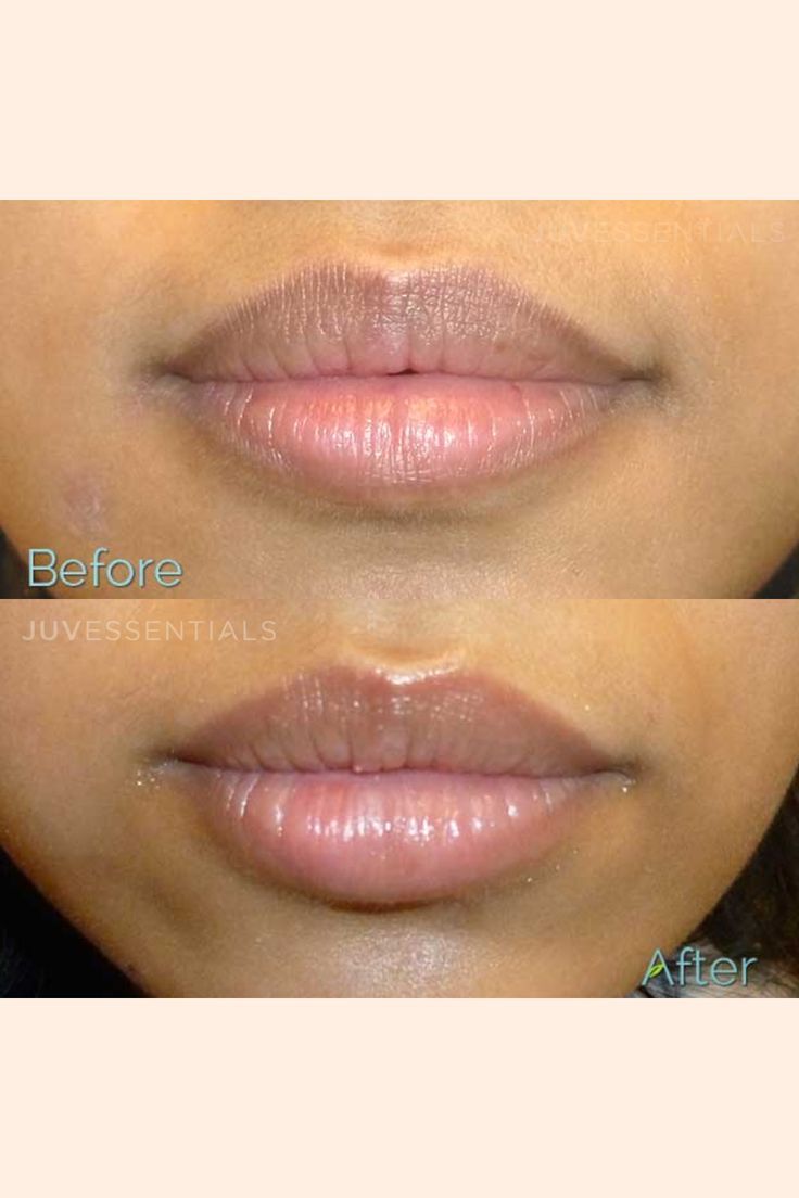 Despigmentación de Labios (Melanosis)