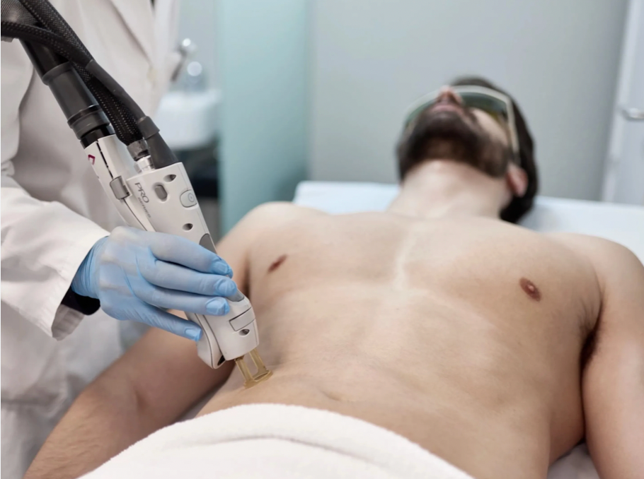 Abdomen Laser Hair Removal (Men)