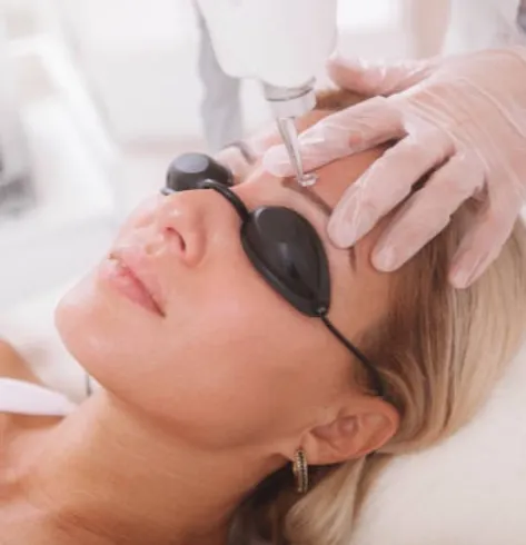 Remoci n L ser de Cejas Tatuadas Microblading Miami So