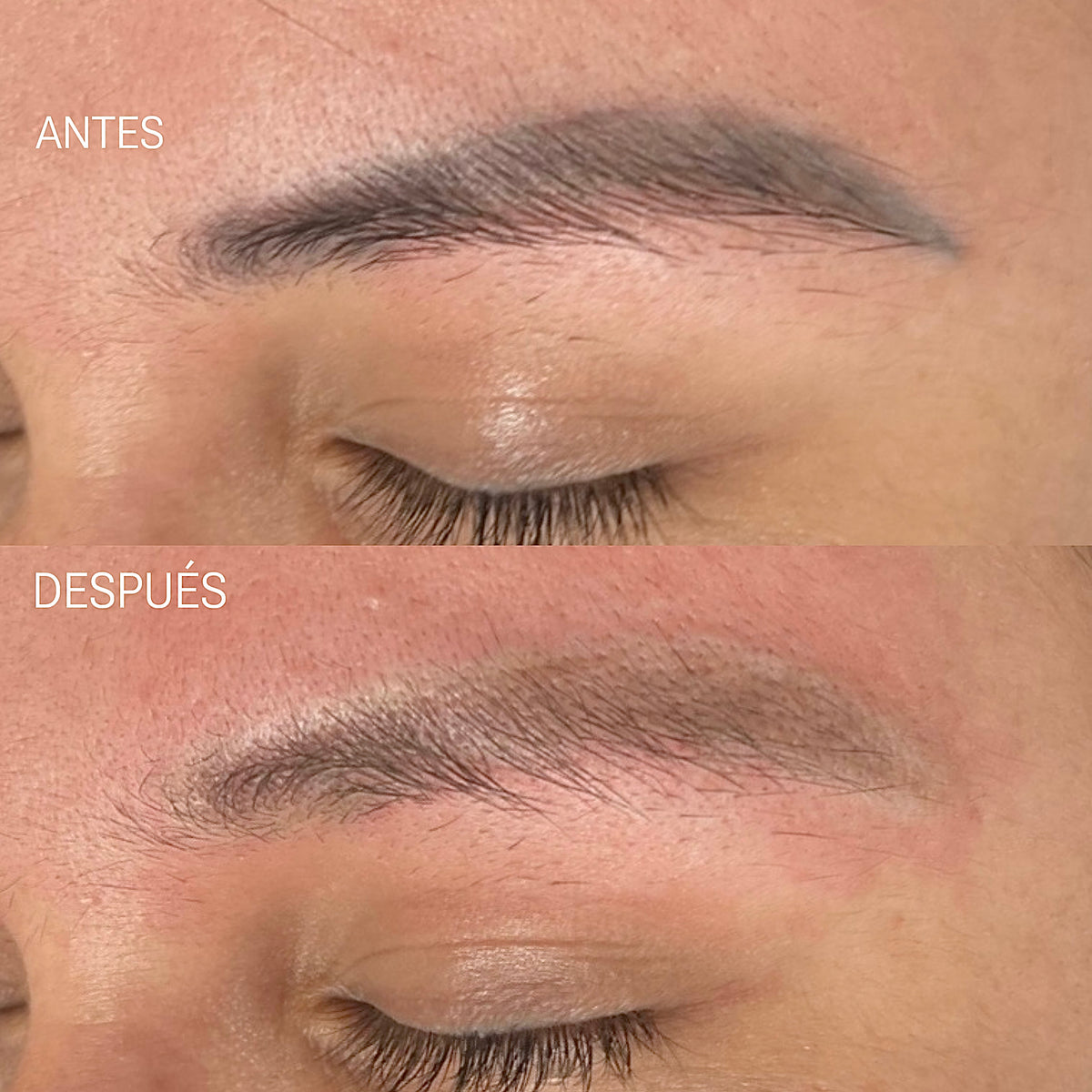 Remoción Láser de Cejas Tatuadas, Microblading y Micropigmentación