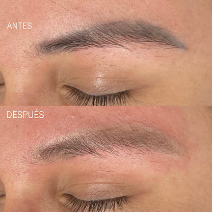 Remoción Láser de Cejas Tatuadas, Microblading y Micropigmentación