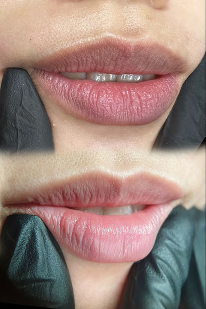 Despigmentación de Labios (Melanosis)