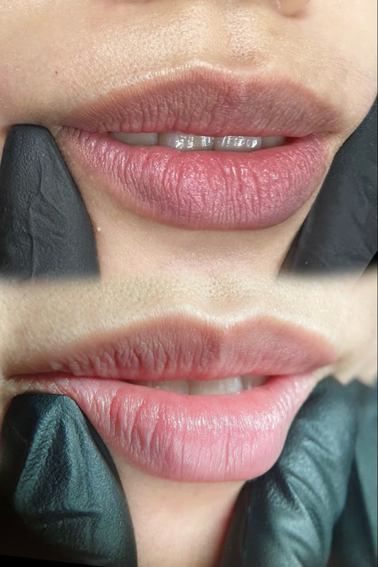 Despigmentación de Labios (Melanosis)