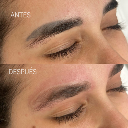 Remoción Láser de Cejas Tatuadas, Microblading y Micropigmentación