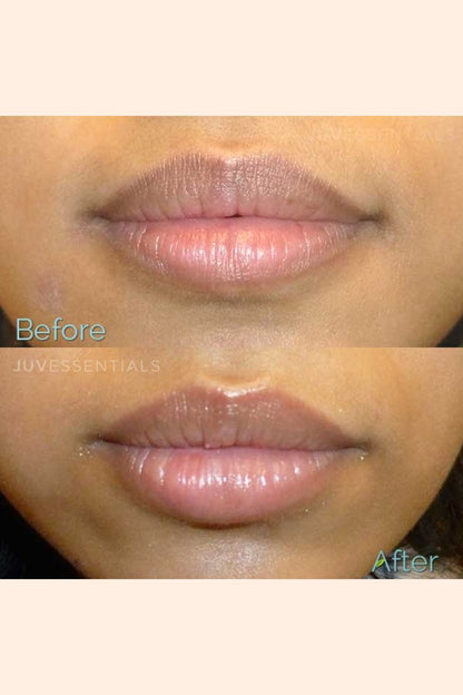 Despigmentación de Labios (Melanosis)