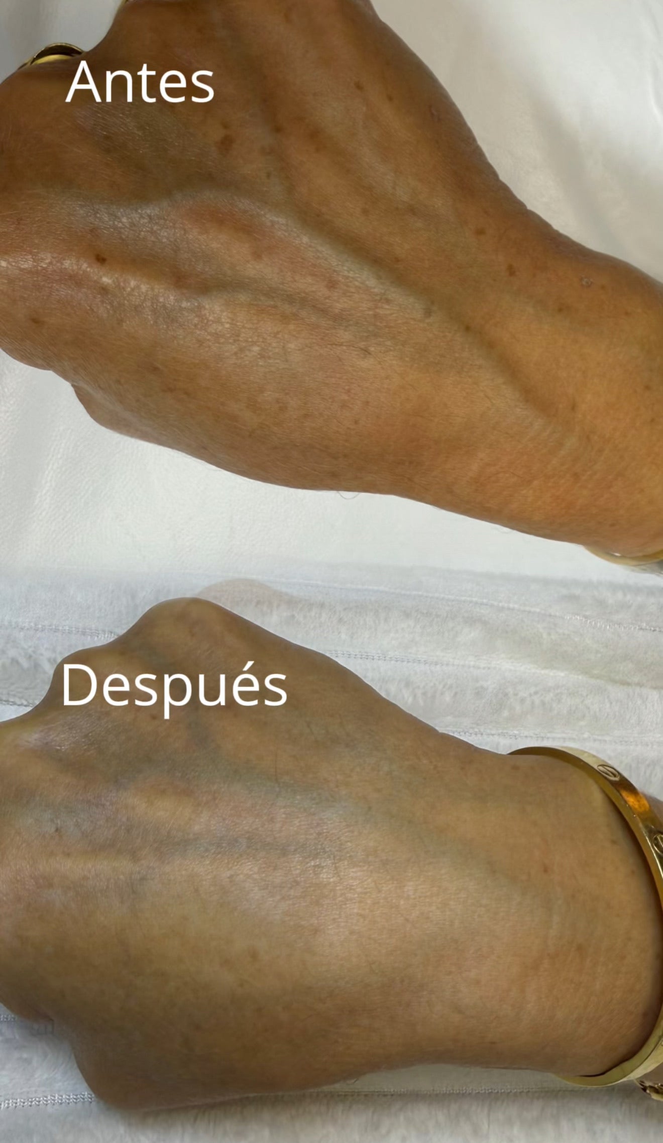 Eliminación de Manchas por Fotolesión con Láser