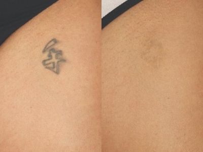 Remoción Láser de Tatuajes Corporales