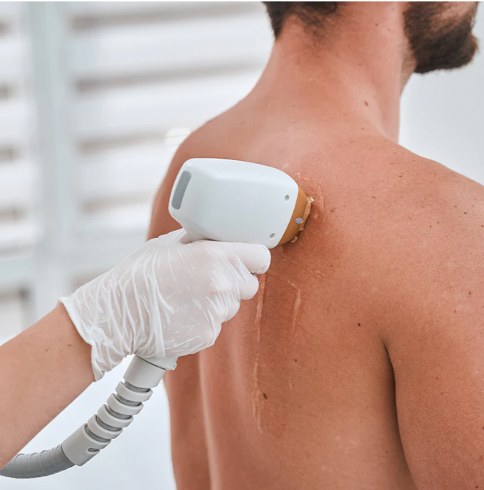 Laser Hair Removal